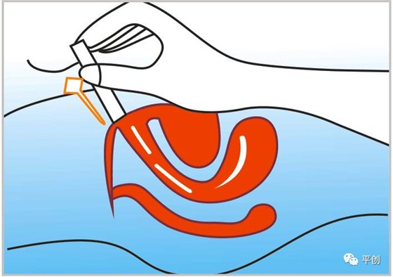陰道填塞使用圖3 陰道填塞使用圖3
