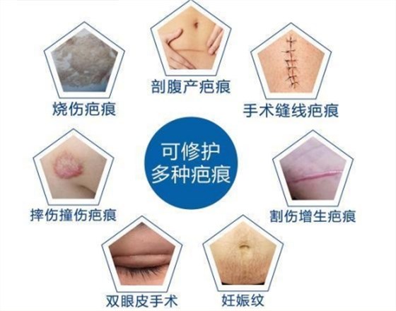 醫用疤痕貼適用范圍 醫用疤痕貼適用范圍