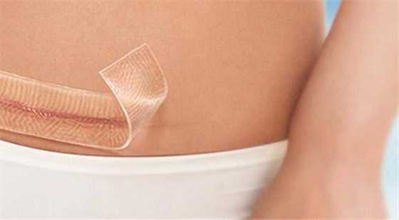 剖腹產疤痕 剖腹產疤痕