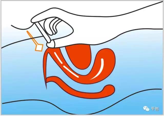 陰道填塞使用圖1 陰道填塞使用圖1