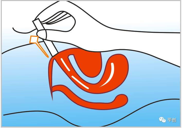 陰道填塞使用圖3 陰道填塞使用圖3