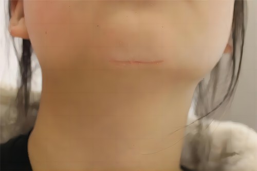 疤痕2 疤痕2